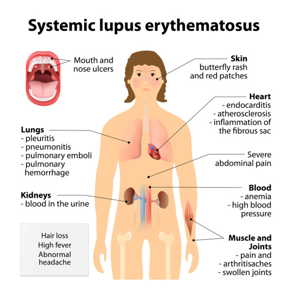 lupus